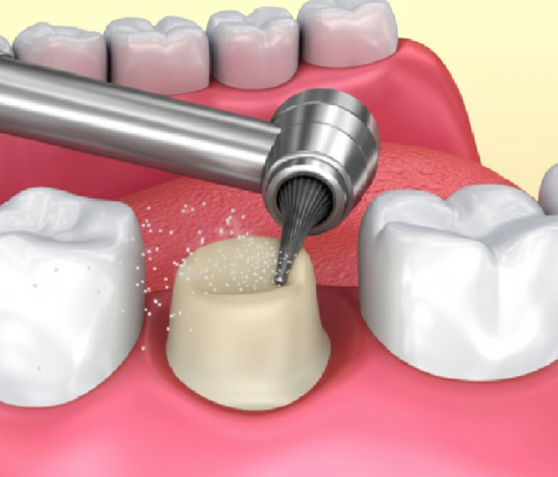 Sau khi mài răng 3 - 5 ngày sẽ hết ê buốt